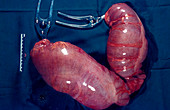 Twisted intestine