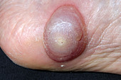 Blister following verruca cryotherapy