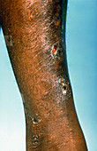 Skin lesions from Yaws