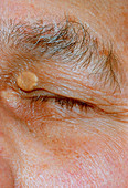 Xanthelasma,a fat deposit on upper eyelid