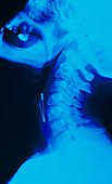 X-ray of object (safety pin) lodged in throat