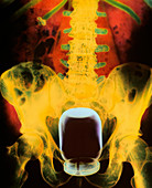 Coloured X-ray of jam jar in rectum