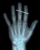 Nail in fingers,X-ray