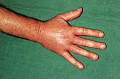 Oedema of hand following insect bite