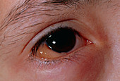 Inflamed eye due to an allergy response to pollen