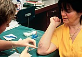 Allergy test: skin biopsy taken from woman's arm