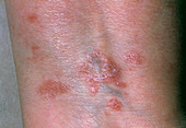 Lichenoid rash due to drug reaction