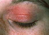 Allergic reaction to cosmetic eye make-up
