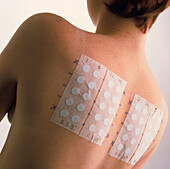 Young woman with allergy test patches on