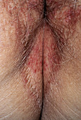 Vulval dermatitis