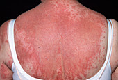 Rash from drug allergy