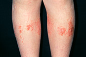 Allergic contact dermatitis