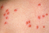 Flea bite marks
