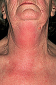 Angioedema