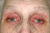 Eye drop allergy