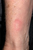 Drug-induced rash on wrist