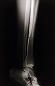 X-ray of a break in leg tibia bone