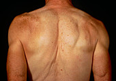 Dislocation of the shoulder