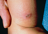 Child abuse: wound caused by cigarette burn