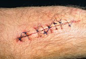 Stitched wound