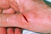 Deep cut to the thumb