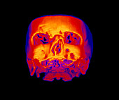 False-colour 3-D CT scan of broken nasal bone