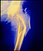 Col X-ray showing the compound fracture of a femur