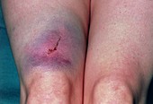 Large haematoma on leg resulted from a horse kick