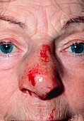 Close-up of elderly woman with a fractured nose