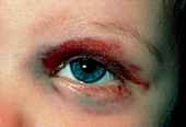 Close-up of black eye in child