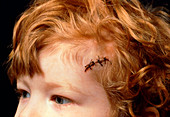 Child with sutured head wound