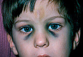 Fractured nose in young boy