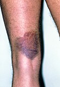 Bruising behind man's knee due to torn hamstring