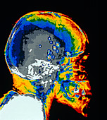 Coloured CT scan showing lead shots in head