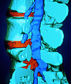 3-D computed tomography scan of slipped disc