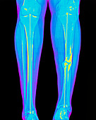 Coloured X-ray of fractured shin bone (tibia)