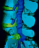 Slipped spinal disc