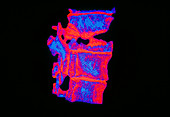 Coloured 3-D CT scan of a fractured vertebra