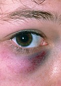 Black eye (periorbital bruising)