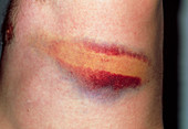 Rib bruising following assault with iron bar