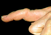 Close-up of dislocated phalanx in finger