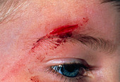 Laceration above the eyebrow of a 5-year-old boy