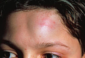 Swelling of forehead due to injury in child