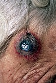 Haematoma of the head of elderly woman on steroids