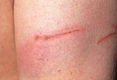 Close-up of scratched and bruised arm on day 2