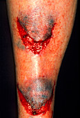 Lacerations on the leg of elderly woman after fall