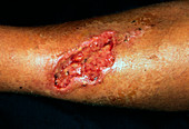 Open wound on elderly woman's leg after two weeks