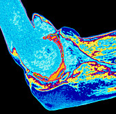 Coloured X-ray of elbow joint injury due to RSI