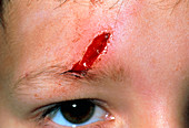 Laceration above the eye of a 5 year old boy