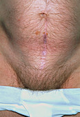 Incisional hernia caused by appendicectomy